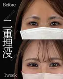 Dr岩切🌟二重埋没🌟 30日後 サムネイル用