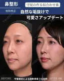 鼻整形（他院修正） before画像 サムネイル用