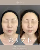 糸リフト before画像 サムネイル用