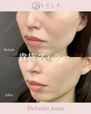 貴族フィラー before画像 サムネイル用