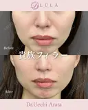貴族フィラー after画像 サムネイル用