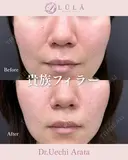 貴族フィラー before画像 サムネイル用