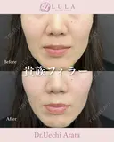 貴族フィラー before画像 サムネイル用