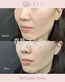 貴族フィラー after画像 サムネイル用