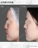 耳珠軟骨移植 before画像 サムネイル用