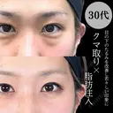 目の下のクマ取り/脂肪注入(目の下・ゴルゴライン) 90日後 サムネイル用