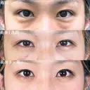 目の下のクマ取り/脂肪注入(目の下・ゴルゴライン) before画像 サムネイル用