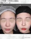 人中短縮・口角挙上(全層法)・貴族プロテーゼ before画像 サムネイル用