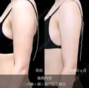 二の腕　肩　脇肉　脂肪吸引 before画像 サムネイル用