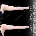 二の腕　肩　脇肉　脂肪吸引 180日後 サムネイル用