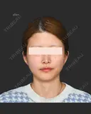 頬脂肪吸引＋エラボトックス 0日後 サムネイル用
