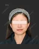 頬脂肪吸引＋エラボトックス before画像 サムネイル用