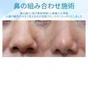 【30代女性・鼻の組み合わせ施術】鼻尖縮小＋鼻尖形成（耳介軟骨移植）＋小鼻縮小 before画像 サムネイル用