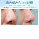 【30代女性・鼻の組み合わせ施術】鼻尖縮小＋鼻尖形成（耳介軟骨移植）＋小鼻縮小 after画像 サムネイル用