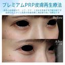 【20代女性・目の下のクマ、たるみ治療】プレミアムPRP皮膚再生療法 30日後 サムネイル用