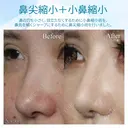 【20代女性・理想の鼻に】鼻の複合手術（プロテーゼ、鼻尖縮小、鼻翼軟骨移植、小鼻縮小） 30日後 サムネイル用