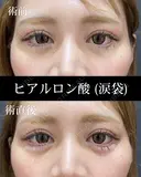 涙袋ヒアルロン酸 after画像 サムネイル用