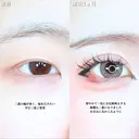 アリエルクイックループトリプル二重埋没法 before画像 サムネイル用