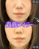 貴族フィラー 0日後 サムネイル用