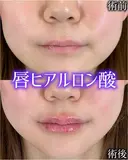 Cカールリップ 0日後 サムネイル用