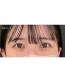 涙袋ヒアルロン酸 before画像 サムネイル用