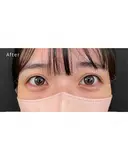 涙袋ヒアルロン酸 0日後 サムネイル用