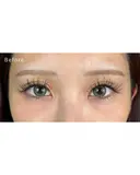 涙袋ヒアルロン酸 before画像 サムネイル用