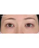 涙袋ヒアルロン酸 before画像 サムネイル用