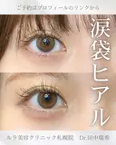 涙袋ヒアルロン酸注入 after画像 サムネイル用