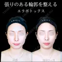 エラボトックス 90日後 サムネイル用