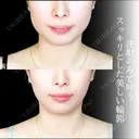 エラボトックス before画像 サムネイル用