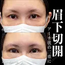 眉下切開 7日後 サムネイル用