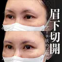 眉下切開 7日後 サムネイル用