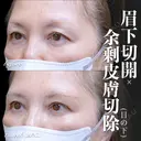眉下切開･余剰皮膚切除(目の下) 7日後 サムネイル用