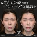 輪郭を整えるヒアルロン酸治療 after画像 サムネイル用