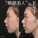 輪郭を整えるヒアルロン酸治療 after画像 サムネイル用