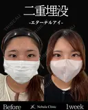 Dr岩切🎀二重埋没🎀 before画像 サムネイル用