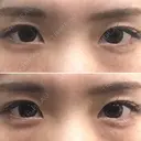 【女性】 蘇原しのぶ院長オリジナル涙袋ヒアルロン酸 after画像 サムネイル用