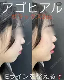 アゴヒアルロン酸　ボラックス2㏄ before画像 サムネイル用