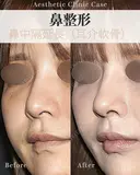 鼻中隔延長　耳介軟骨使用 after画像 サムネイル用