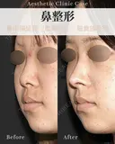 鼻中隔延長肋軟骨使用　猫手術・貴族手術 after画像 サムネイル用