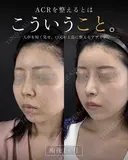 鼻フル after画像 サムネイル用