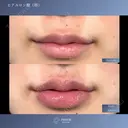 唇ヒアルロン酸 before画像 サムネイル用
