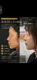 鼻フル　肋軟骨 before画像 サムネイル用