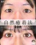 自然癒着法（エターナル二重術） after画像 サムネイル用