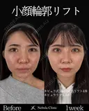 Dr岩切👑小顔整形👑 7日後 サムネイル用