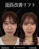 Dr岩切👑小顔整形👑 7日後 サムネイル用