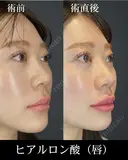 ヒアルロン酸注入（唇） before画像 サムネイル用