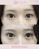 涙袋ヒアルロン酸 after画像 サムネイル用