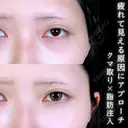 切らない目の下のたるみ取り/目の下・ゴルゴライン脂肪注入 90日後 サムネイル用